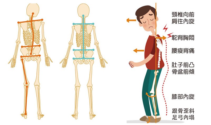 功能性长短脚,又称「假性」长短脚
