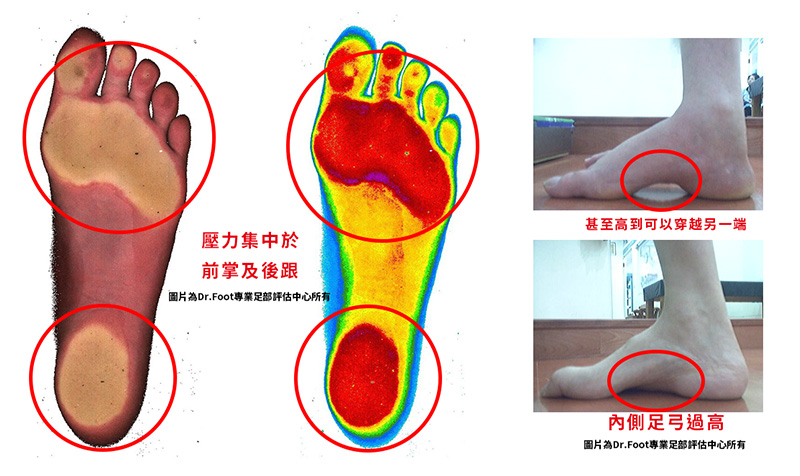 何謂高弓足 對身體有什麼影響